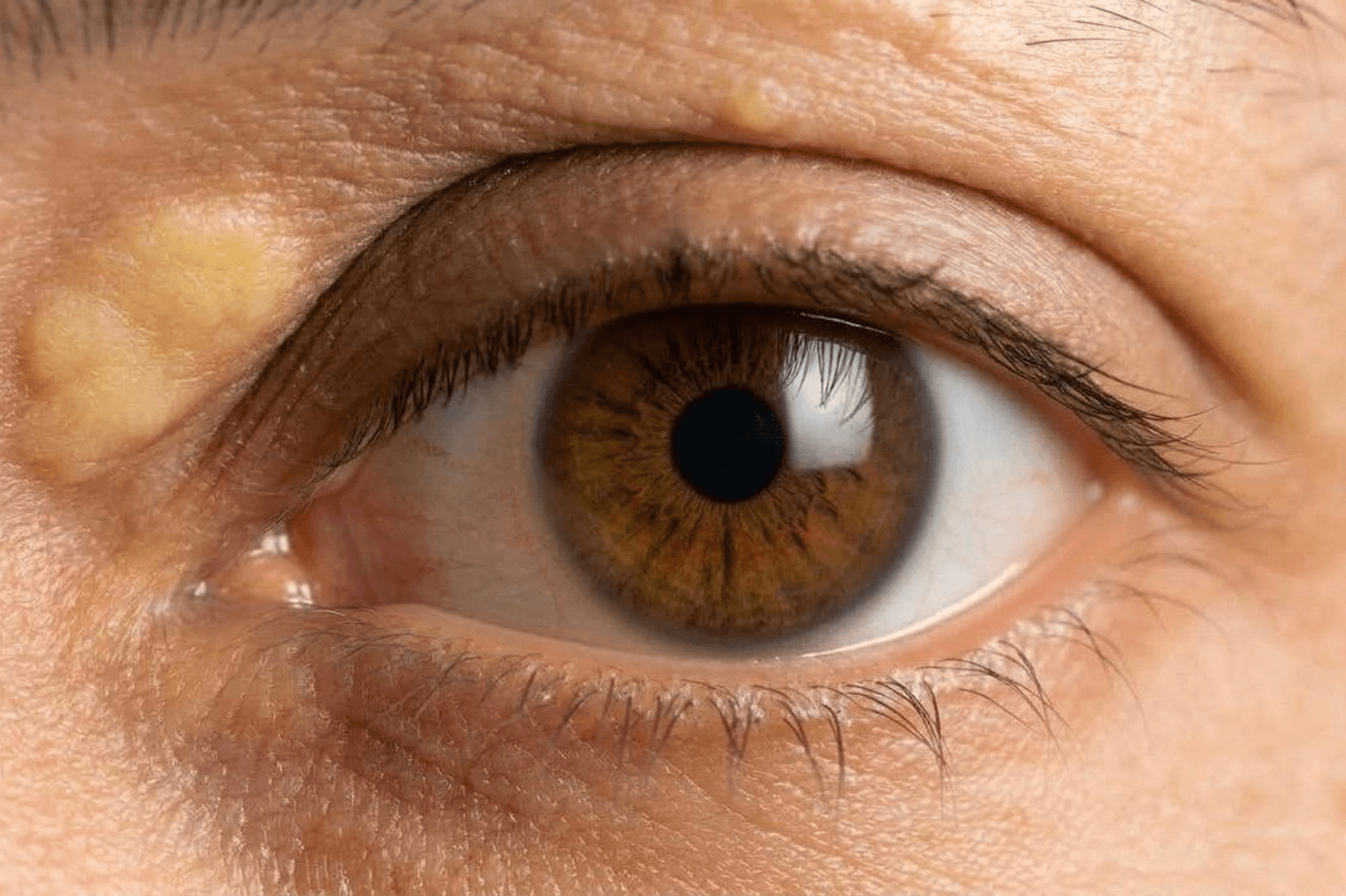 Xantelasma